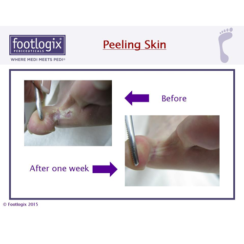 footlogix peeling skin